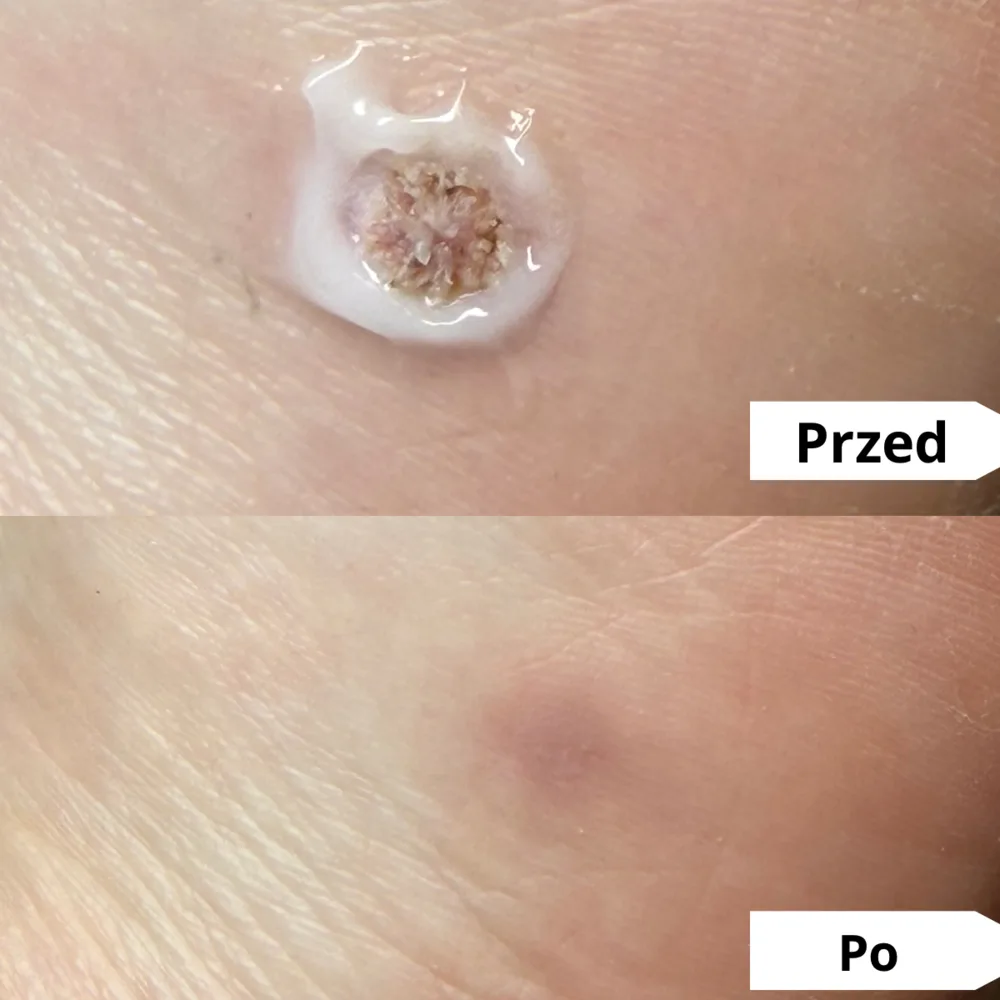 Brodawka na podeszwie stopy — przed i po zabiegu podologicznym (przypadek 2)