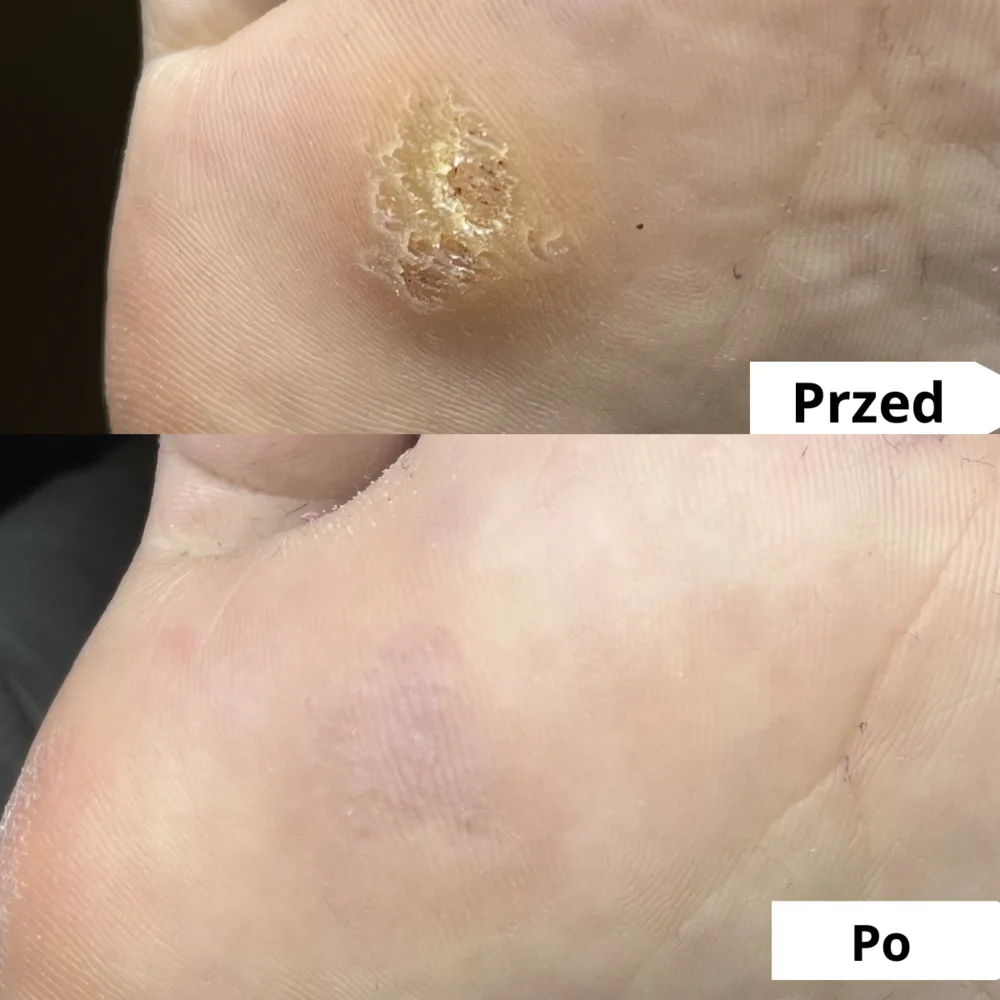 Brodawka na stopie — przed i po zabiegu podologicznym (przypadek 3)