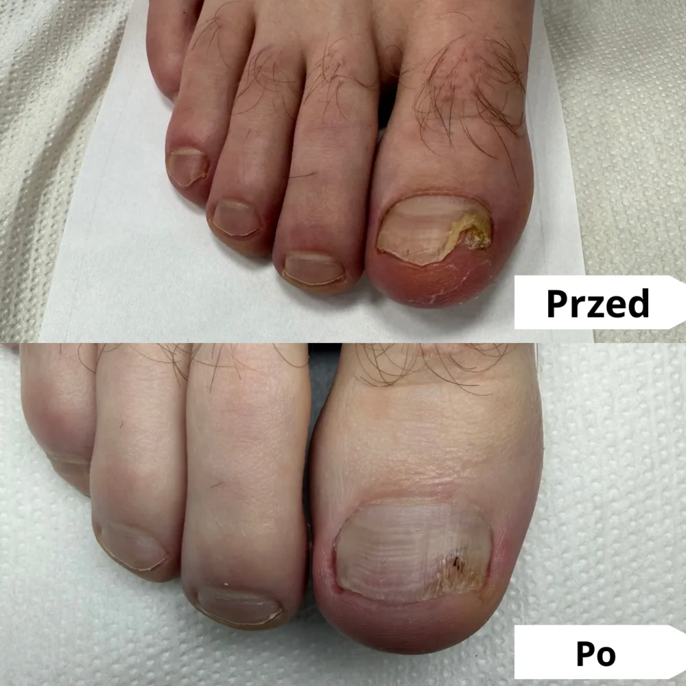 Pogrubiony, żółty paznokieć — przed i po opracowaniu podologicznym (przypadek 2)