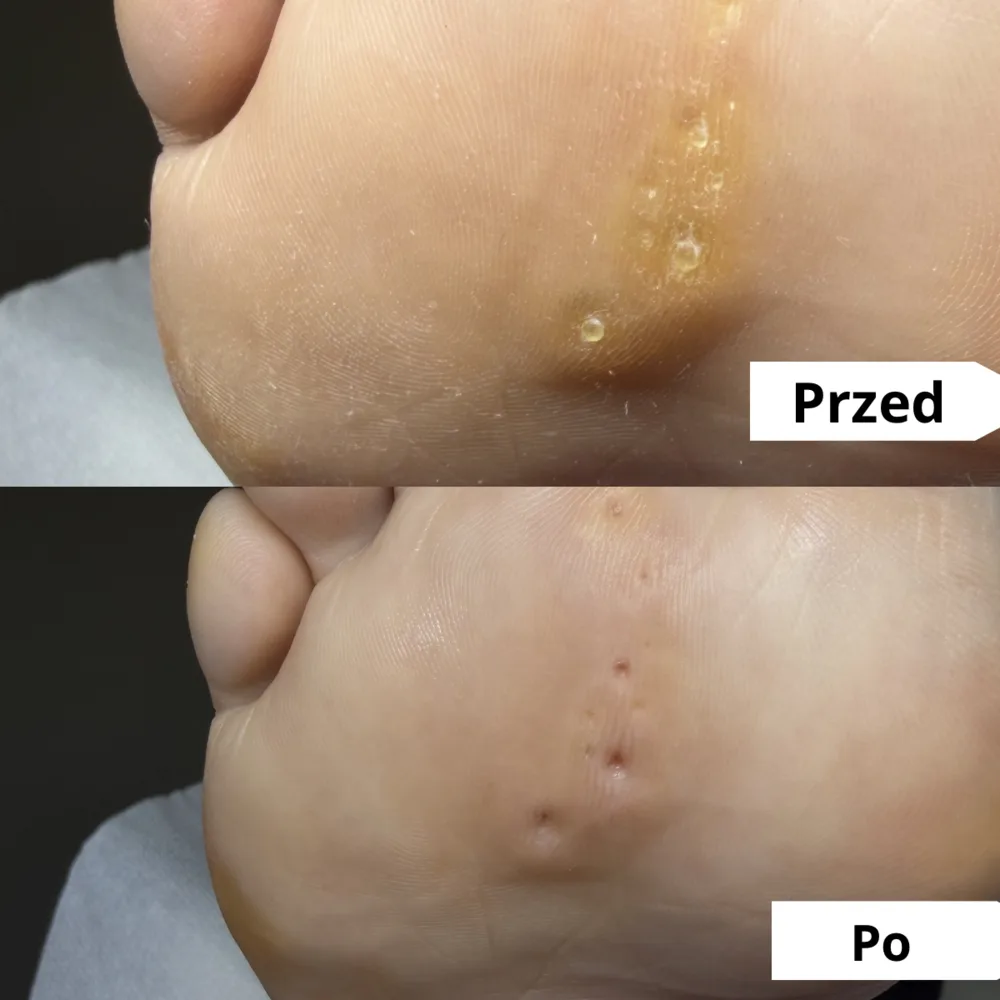 Odciski na przodostopiu — przed i po usunięciu (przypadek 2)