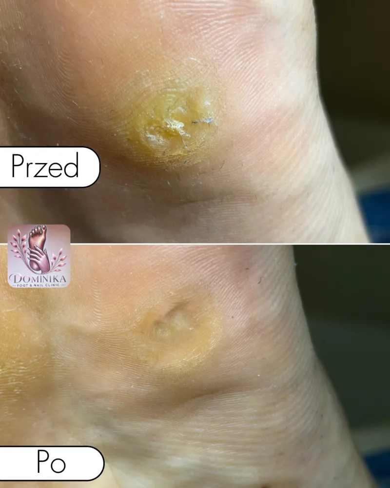 Modzel na pięcie — przed i po opracowaniu podologicznym (przypadek 3)