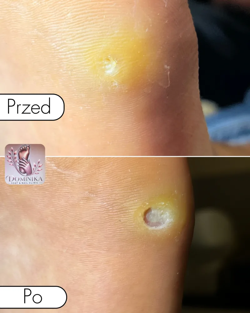 Odcisk z rdzeniem — przed i po usunięciu (przypadek 5)