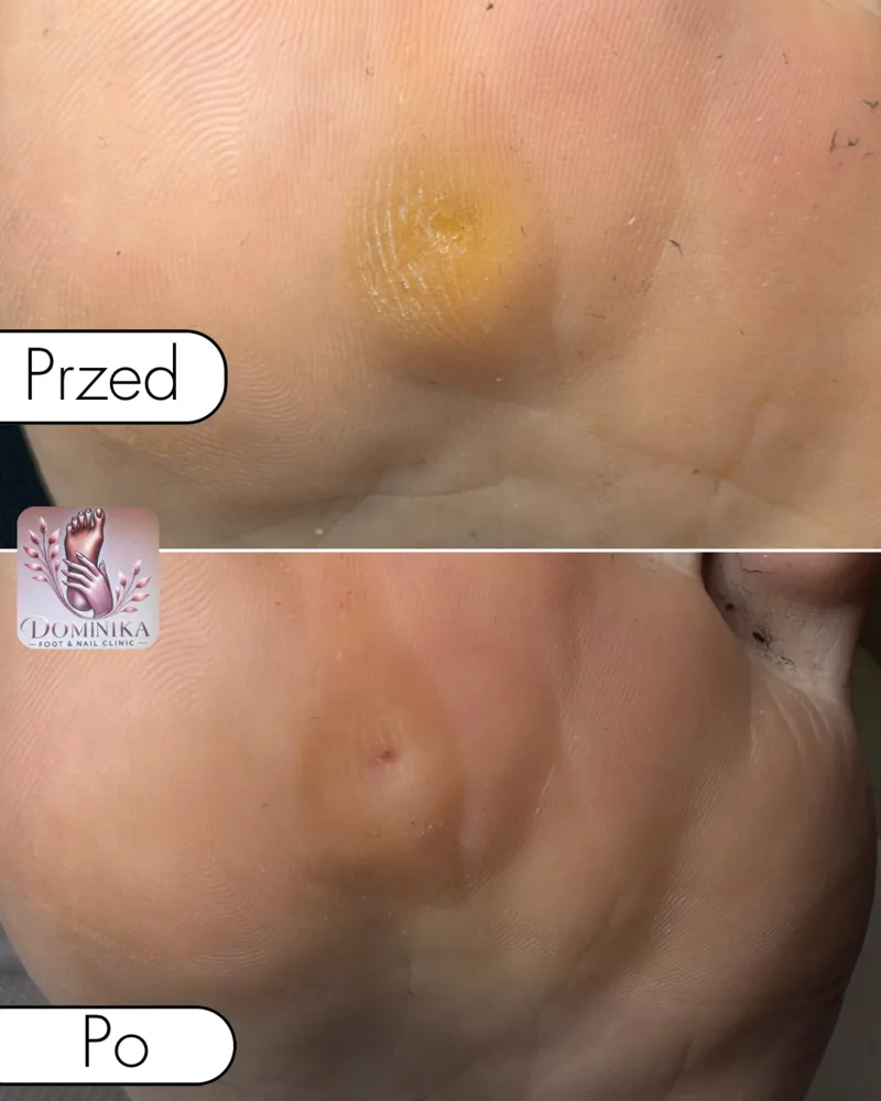 Modzel na podeszwie — przed i po opracowaniu podologicznym (przypadek 6)