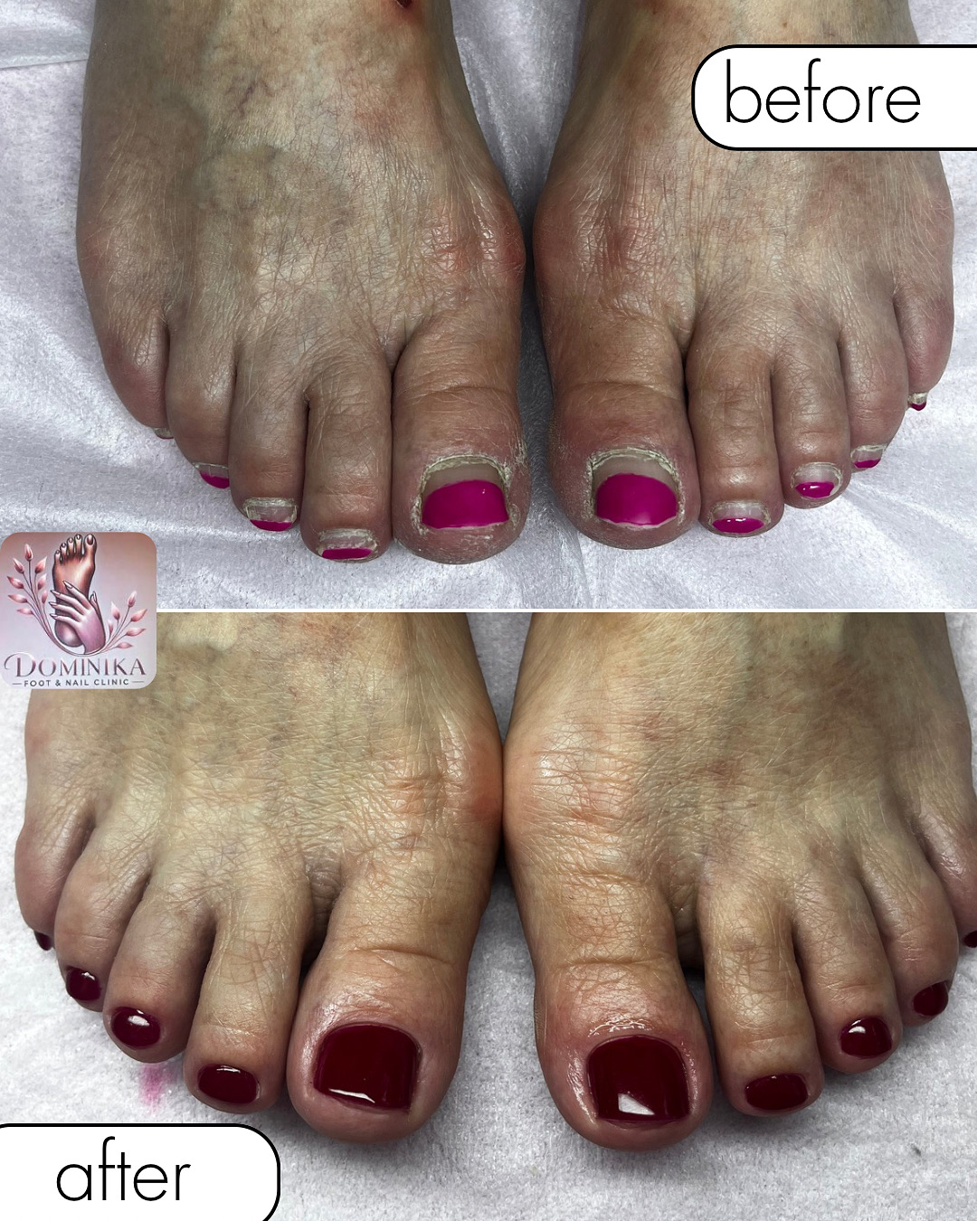 Pedicure podologiczny efekt