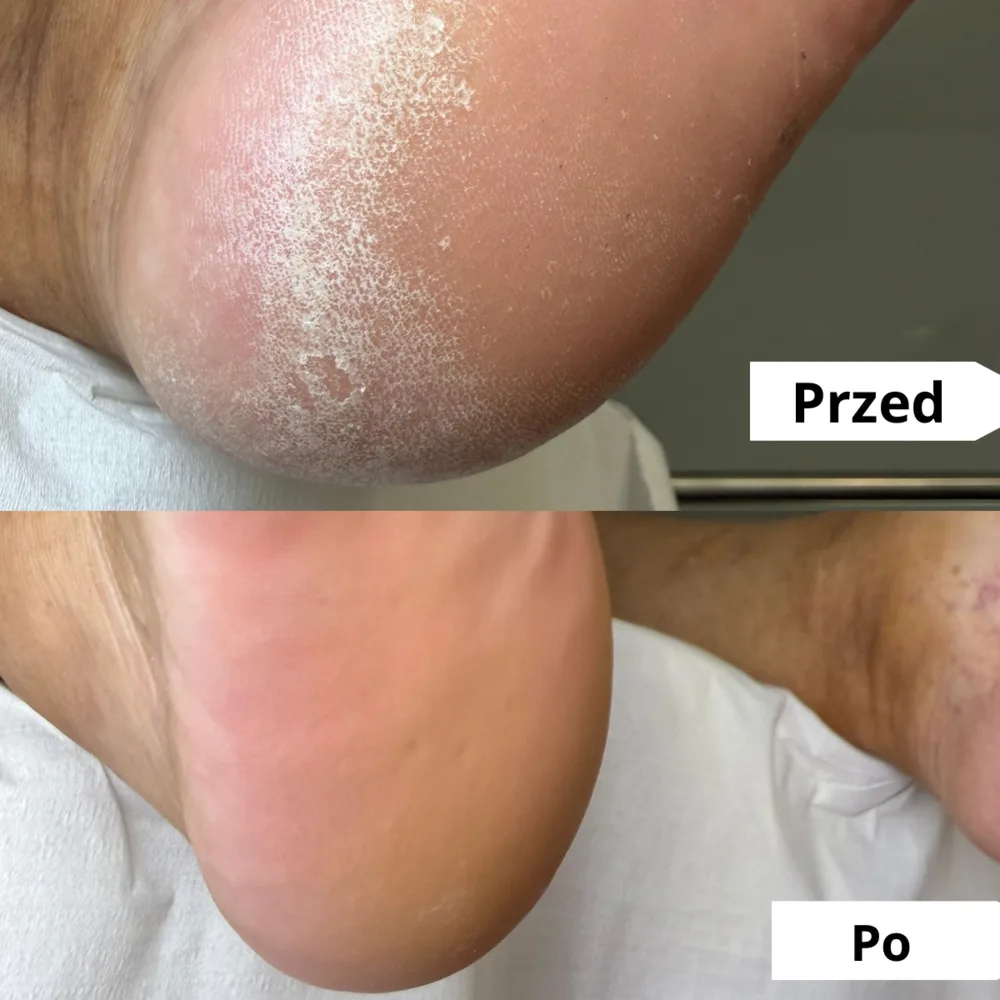 Zrogowaciała skóra pięty — przed i po zabiegu podologicznym (przypadek 2)