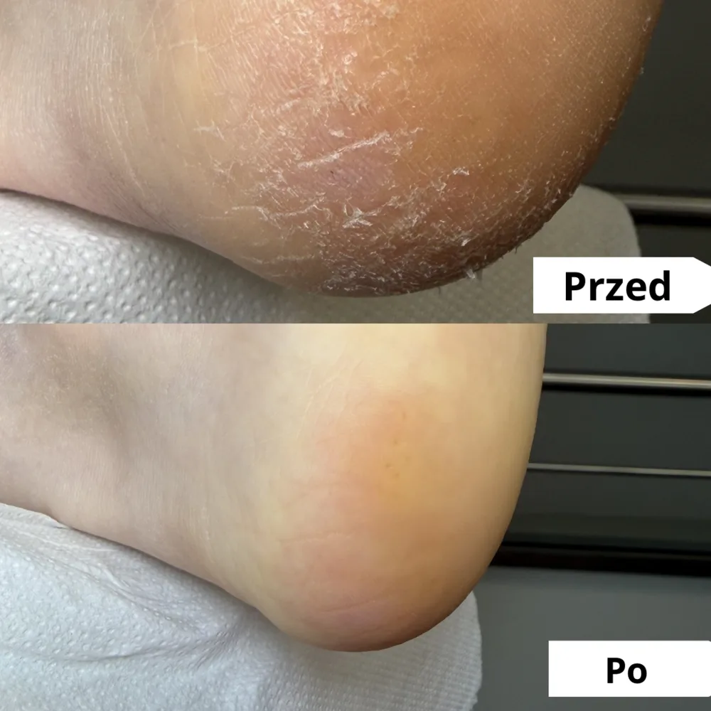 Przesuszona, pękająca pięta — przed i po zabiegu podologicznym (przypadek 3)